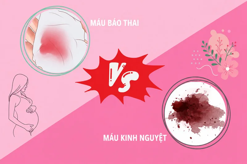 Ra máu báo thai có thể xuất hiện khi phôi làm tổ, nhưng không phải ai mang thai cũng gặp dấu hiệu này và ra máu nhẹ còn có thể do nhiều nguyên nhân khác.